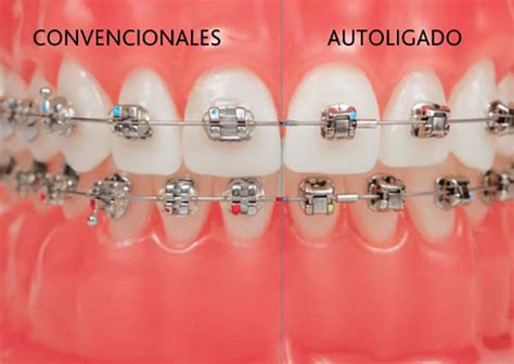 brackets esteticos o metalicos ventajas|bracket autoligado vs convencional.